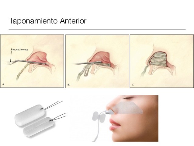 epistaxis taponamiento anterior