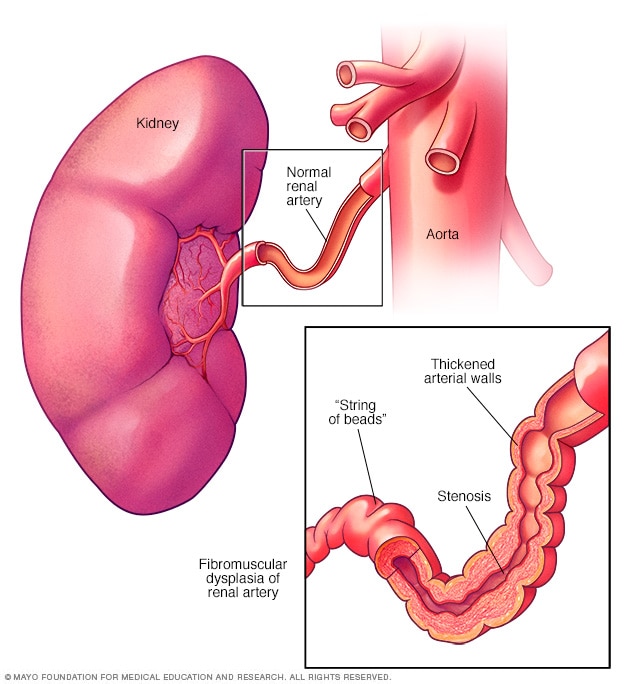displasia fibromuscular renal