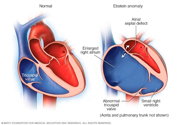 enfermedad de ebstein en nios