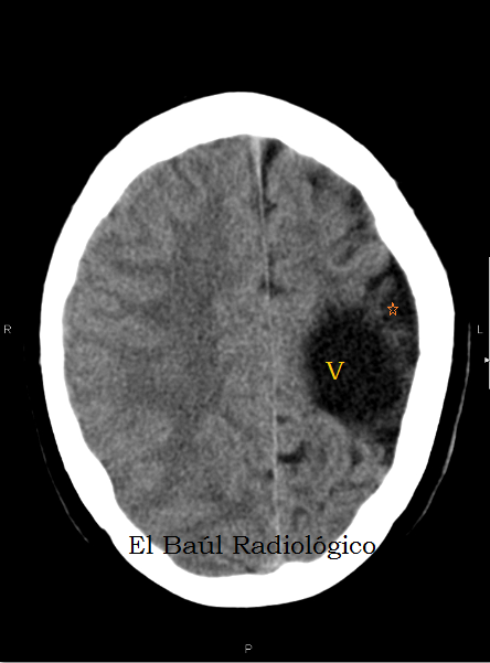 encefalomalacia cerebral