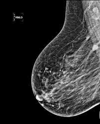 calcificaciones en mamografia