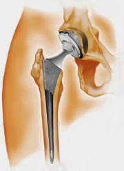 artroplastia da anca