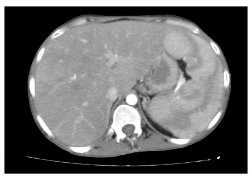 eritropoyesis extramedular