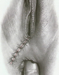 concepto de episiotomia y episiorrafia