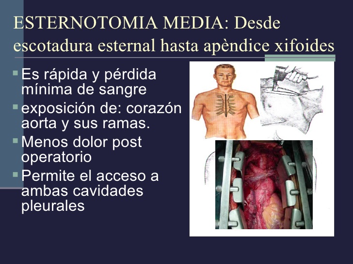 esternotomia media