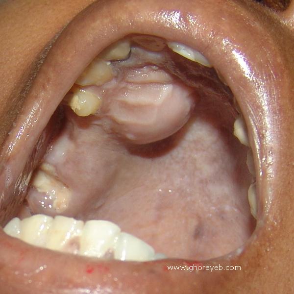 globulomaxillary cyst