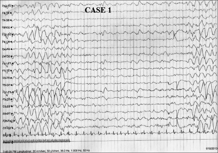 eeg features of angelman syndrome