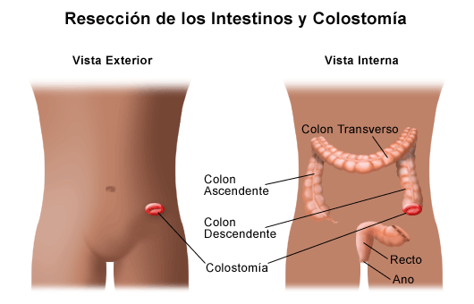 enfermedad de hirschsprung en nios