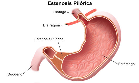 hipertrofia congenita del piloro pediatria