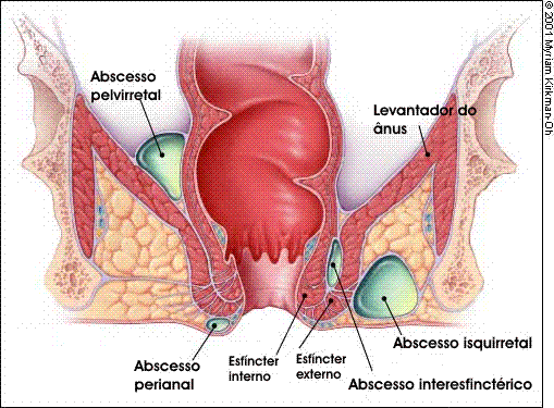 abscesso perianal