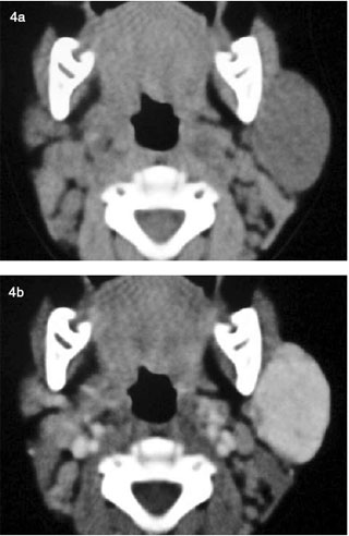 hemangioma parotideo