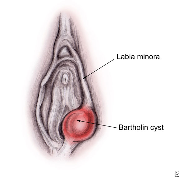 causas de bartolinitis