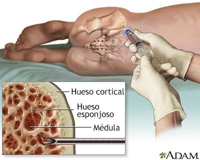 aspirado y biopsia de medula osea