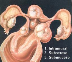 embolizacion de miomas uterinos