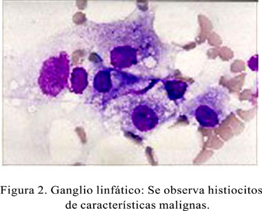 histiocitosis maligna