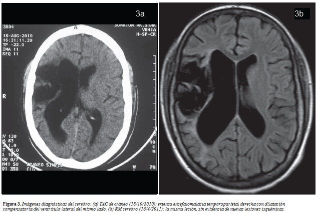 encefalomalacia cerebral