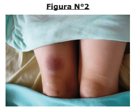 eritema pigmentado fijo por medicamentos