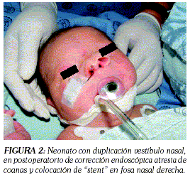 atresia de coanas en pediatria