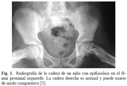 epifisiolisis proximal de femur