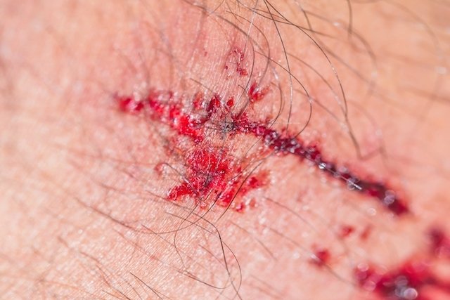 doenca da arranhadura do gato