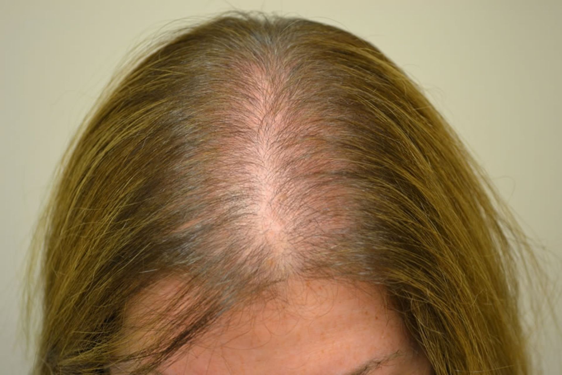 alopecia androgenetica feminina