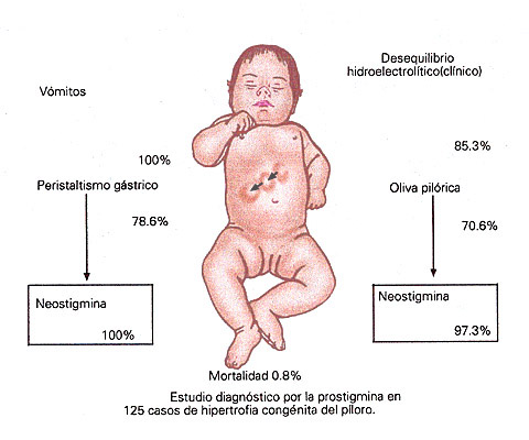 hipertrofia congenita del piloro pediatria