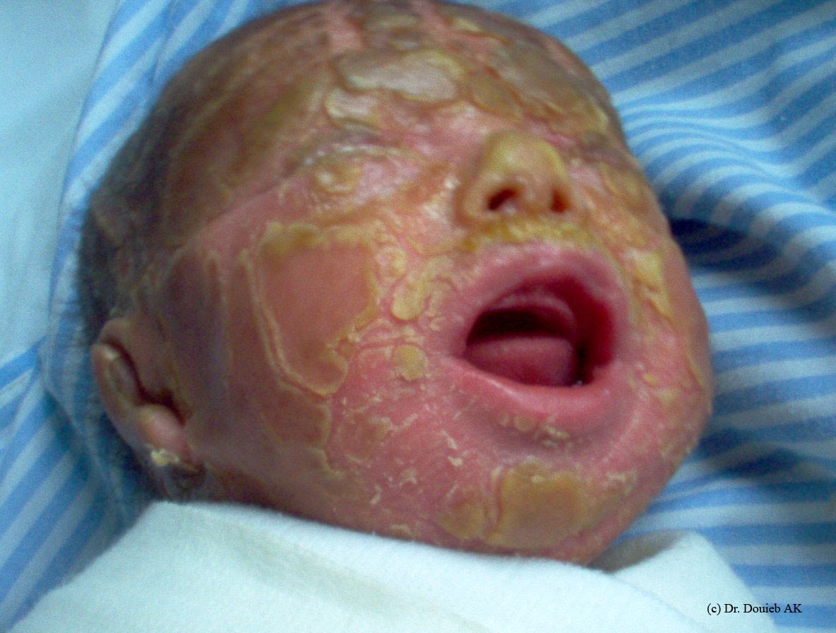 epidermolyse bulleuse