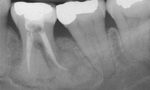 cemento-osseous dysplasia