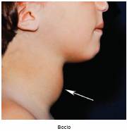 bocio endemico en mexico