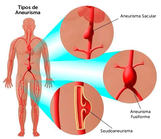 aneurisma aortico abdominal