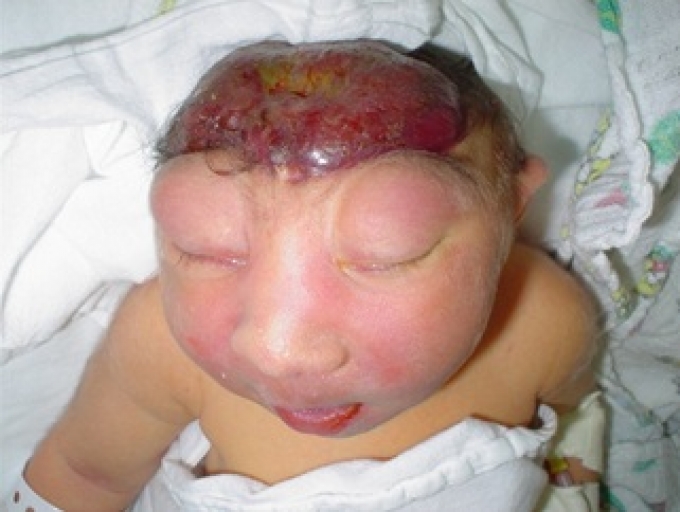 definicion de anencefalia