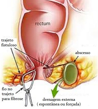 abscesso perianal