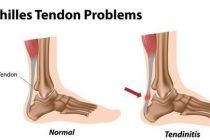 diferencia entre tendinitis y tendinosis