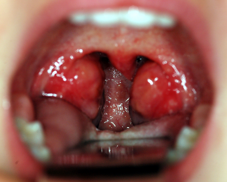 amigdalite tratamento