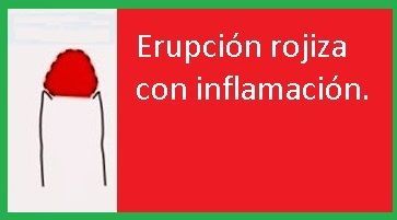 balanitis en nios tratamiento antibiotico