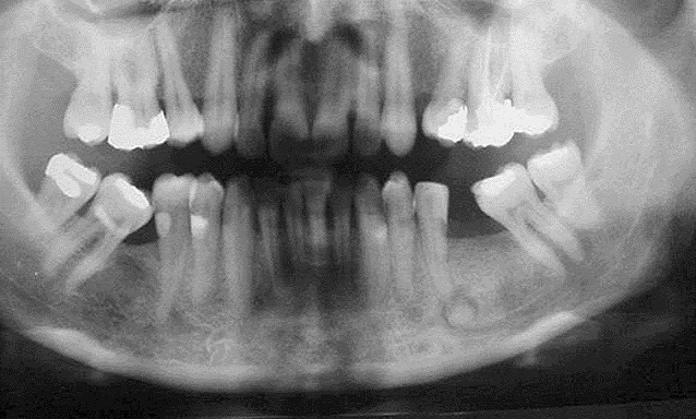 cemento-osseous dysplasia