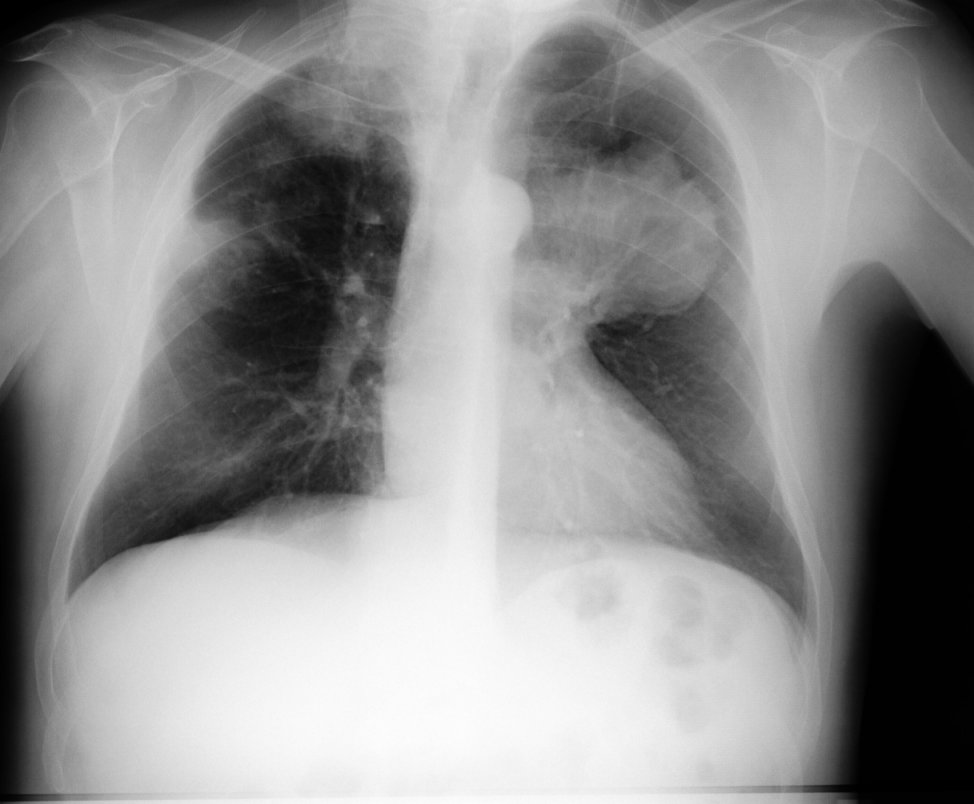 cancer de pulmon broncogenico